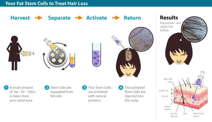 Stem Cell Therapy for Baldness
