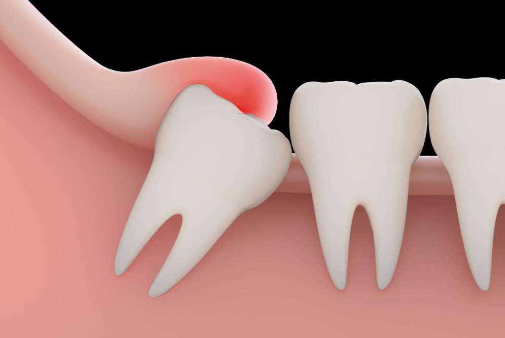 How Long Does It Take To Surgically Remove 4 Wisdom Teeth