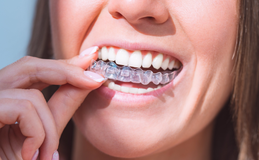 Invisalign treatment