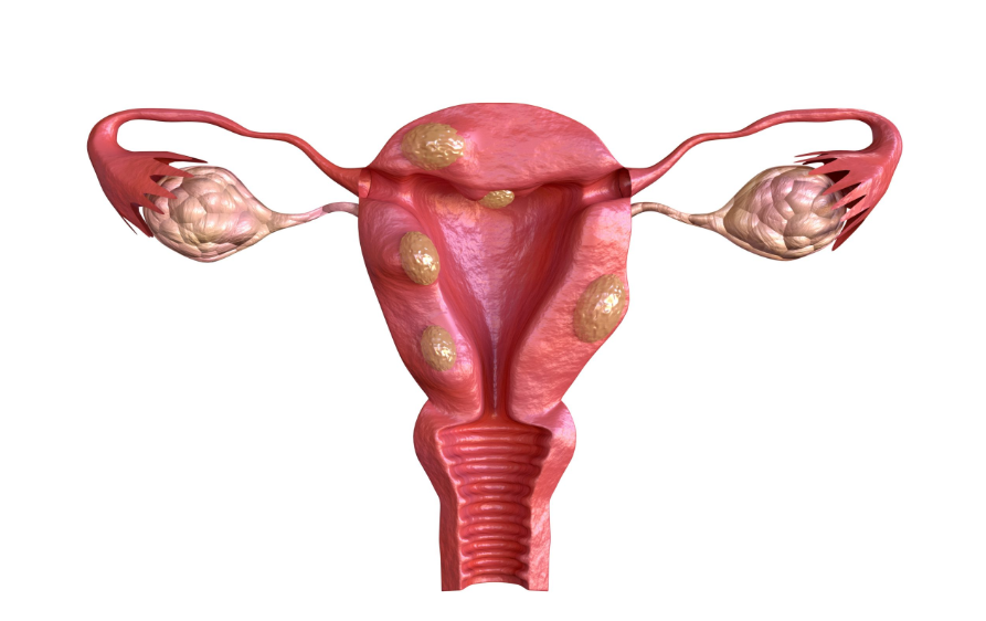 fibroid treatment