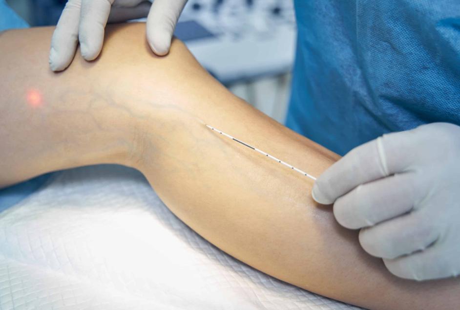 varicose vein removal