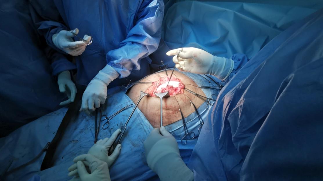 incisional hernia treatment